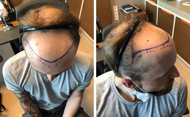 erkek saç ekimi öncesi sonrası 1