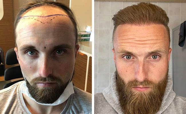 erkek saç ekimi öncesi sonrası 1