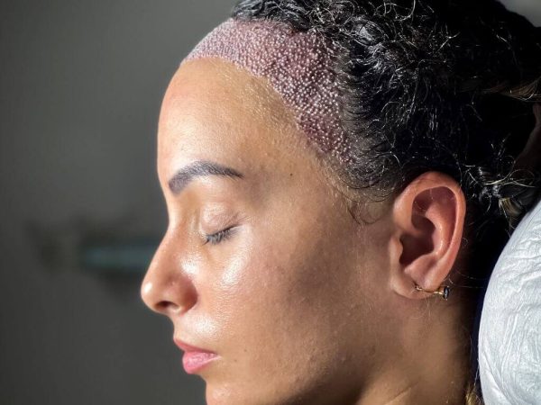 kadin-trassiz-sac-ekimi-1024x1024