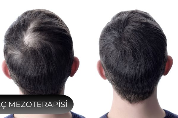 mezoterapi-2 mezoterapi-2