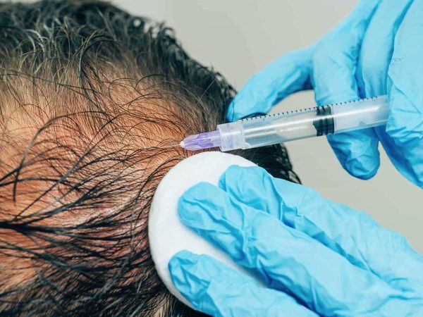 sac-mezoterapisi-erkek sac-mezoterapisi-erkek